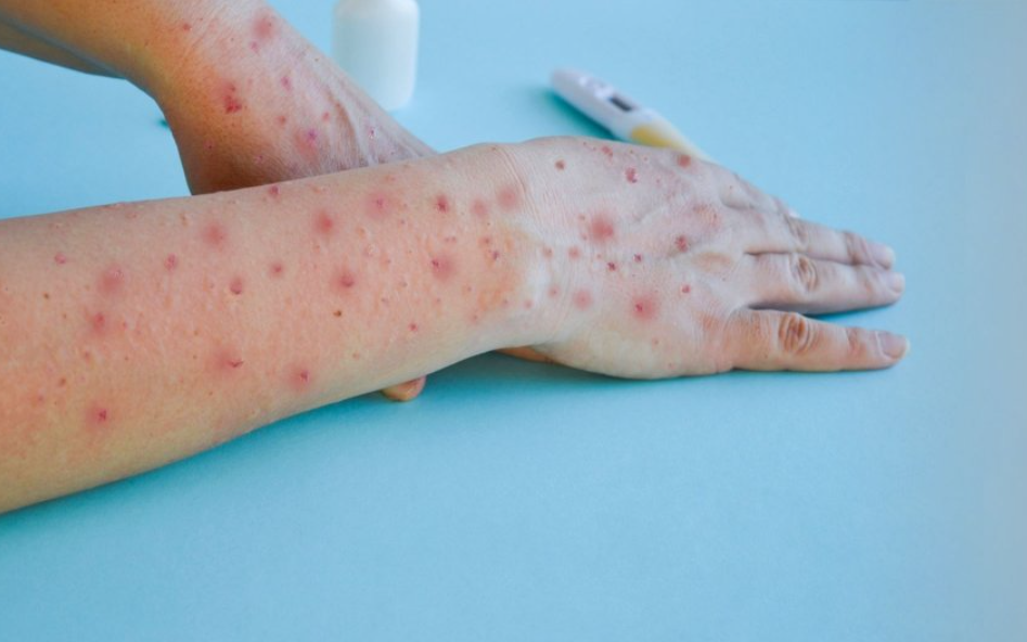 El ayak hastalığı kaç günde geçer El ayak hastalığı kaç günde geçer