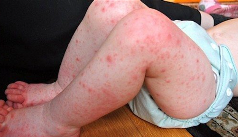 El ayak hastalığı tedavisi El ayak hastalığı tedavisi